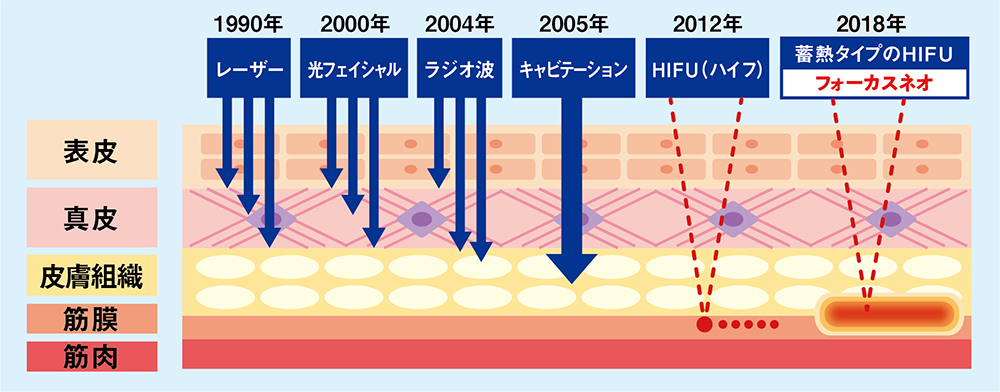 HIFUマシン Focus neo(フォーカスネオ)