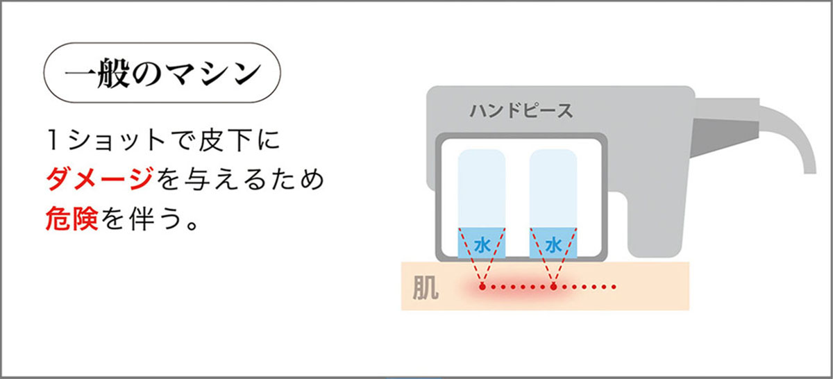 HIFUマシン Focus neo(フォーカスネオ)