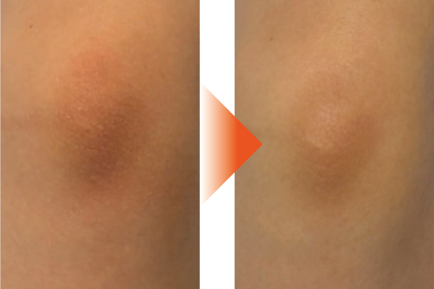 LHALALA PEEL(ララピール)